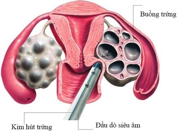 Vì sao phụ nữ thường bị rối loạn kinh nguyệt sau IVF 1