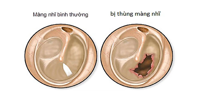 Thủng màng nhĩ để lâu có sao không? 1