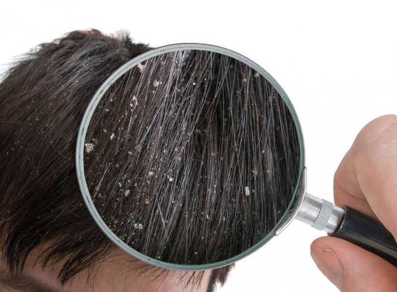 Nguyên nhân, triệu chứng và cách trị nấm da đầu triệt để 2