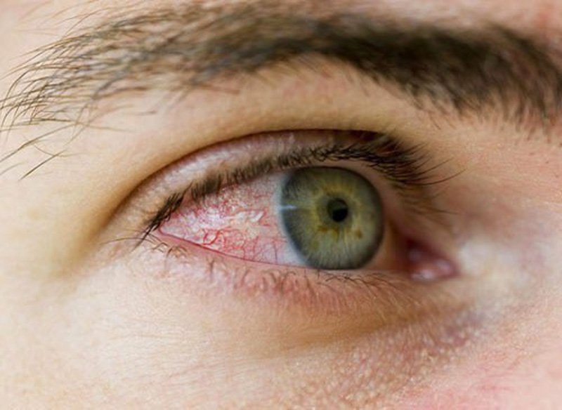 Mách bạn cách nhận biết và điều trị dị ứng mắt hiệu quả 1