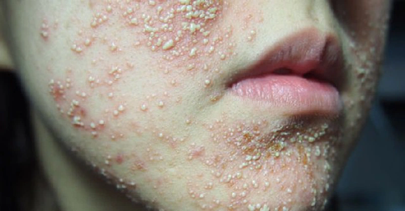 Trangala là thuốc gì? Những điều lưu ý khi sử dụng thuốc Trangala 3
