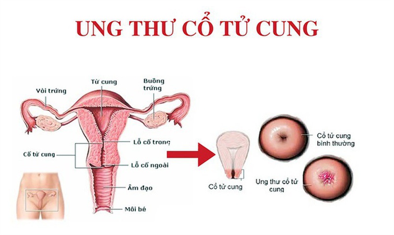 HPV là một trong những nguyên nhân gây ung thư cổ tử cung