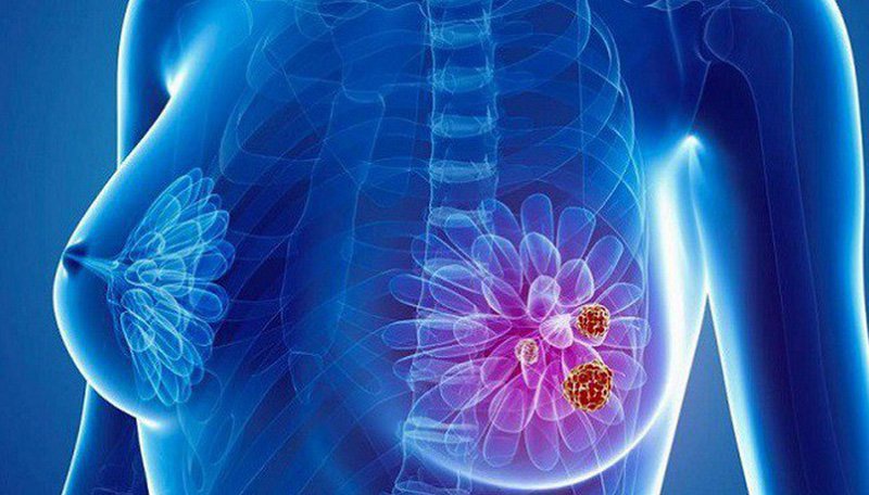 Sự hình thành khối u tiểu thùy và nguy cơ phát triển ung thư vú 3