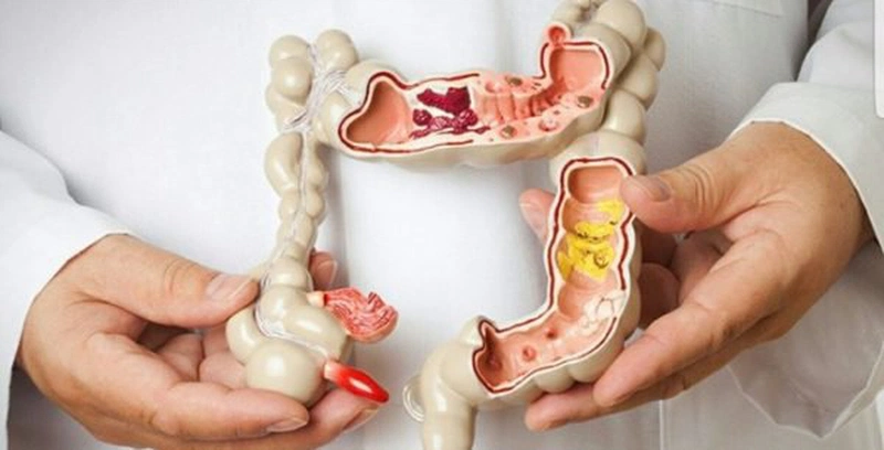 Tác dụng phụ táo bón trong điều trị ung thư2