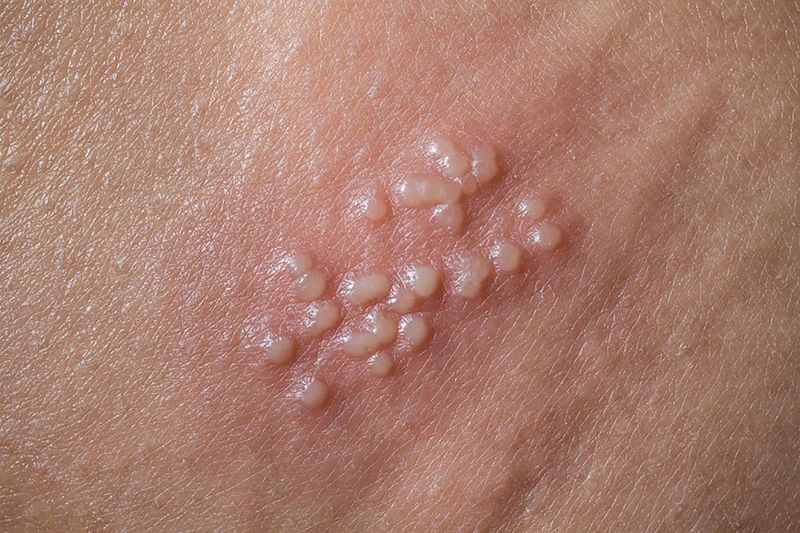 [Góc giải đáp] Sùi mào gà tự đào thải được hay không? 1