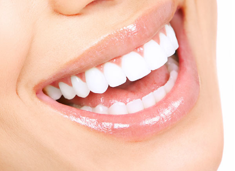 Góc tìm hiểu: Nên niềng răng hay bọc sứ tốt hơn? 2