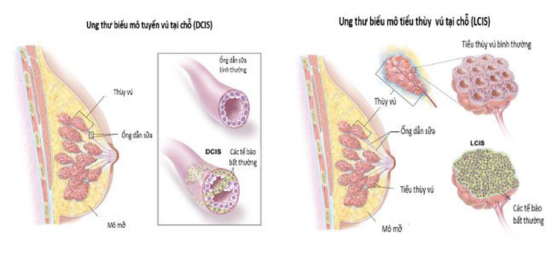 Ung thư biểu mô ống tuyến vú tại chỗ (Nội ống) (DCIS)1
