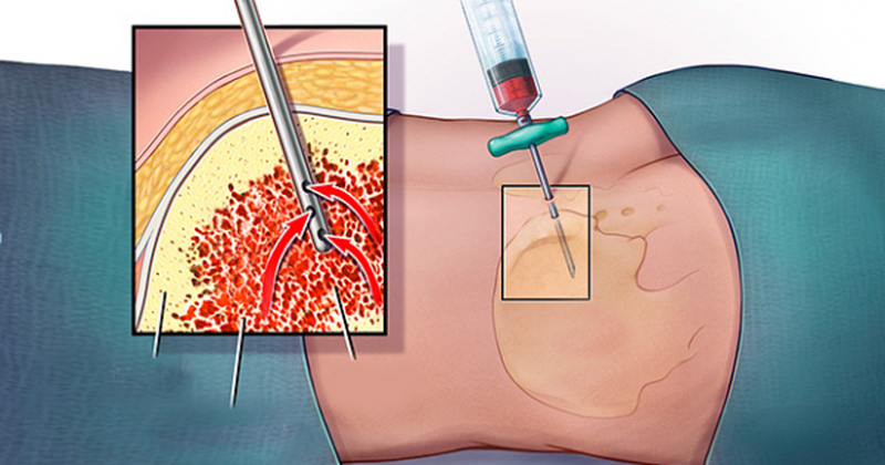 Chọc hút tủy xương hoặc sinh thiết tủy xương dưới gây mê1