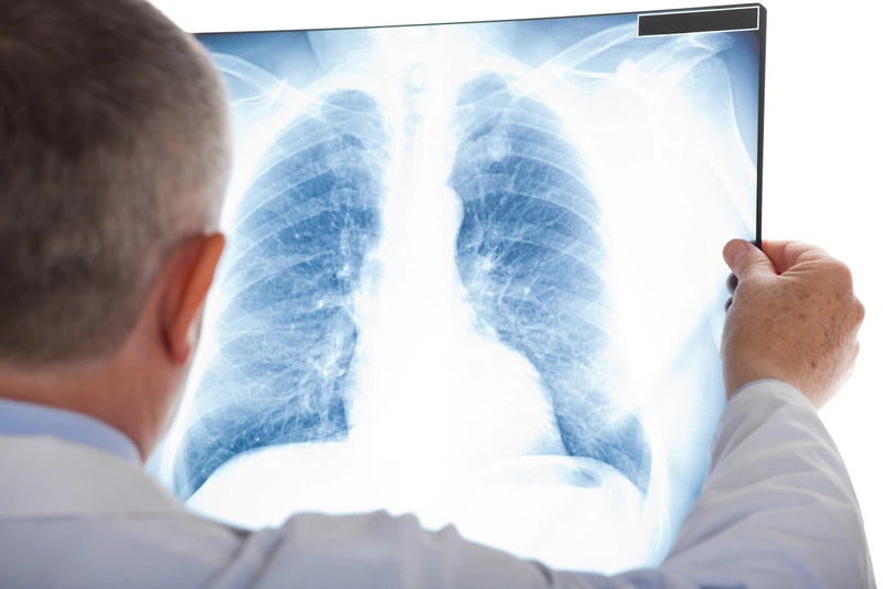 Xơ phổi sau lao ảnh hưởng như thế nào đến sức khỏe người bệnh? 2