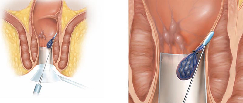 Các cách điều trị bệnh trĩ độ 4 hiệu quả nhất 1