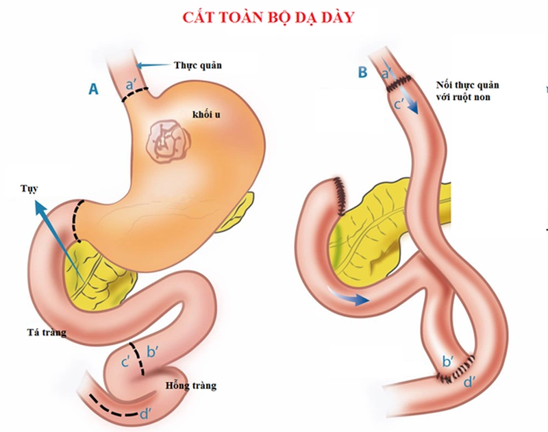 Sinh hoạt thường ngày sau mổ cắt dạ dày2