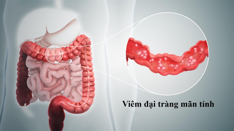 Bệnh viêm đại trực tràng có nguy hiểm không? 1