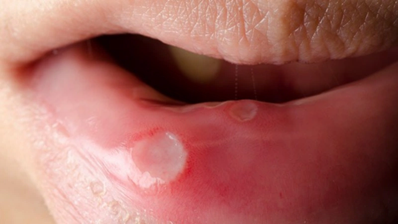 Đau, lở loét họng và miệng trong ung thư1