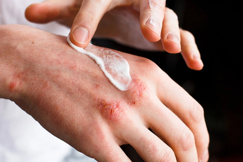 Gợi ý cho bạn một số thuốc bôi lupus ban đỏ dạng đĩa hiệu quả 4