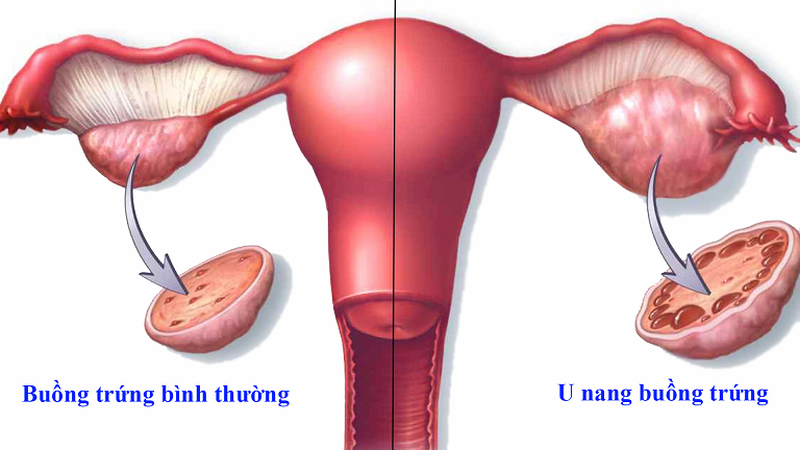 Những điều cần biết về u nang buồng trứng gây rối loạn kinh nguyệt 2