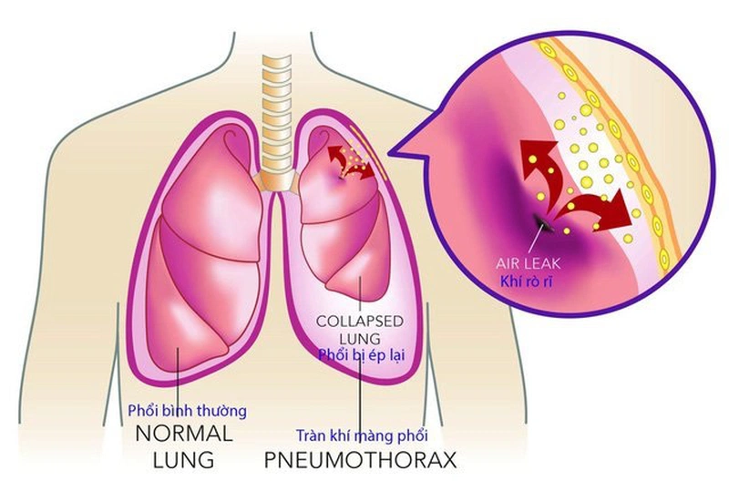 Ung thư màng phổi là gì? Ung thư màng phổi có nguy hiểm không? 2