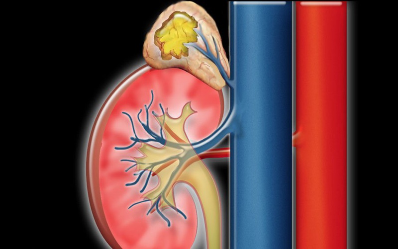 Ung thư phổi di căn tuyến thượng thận và phương pháp chữa bệnh 1