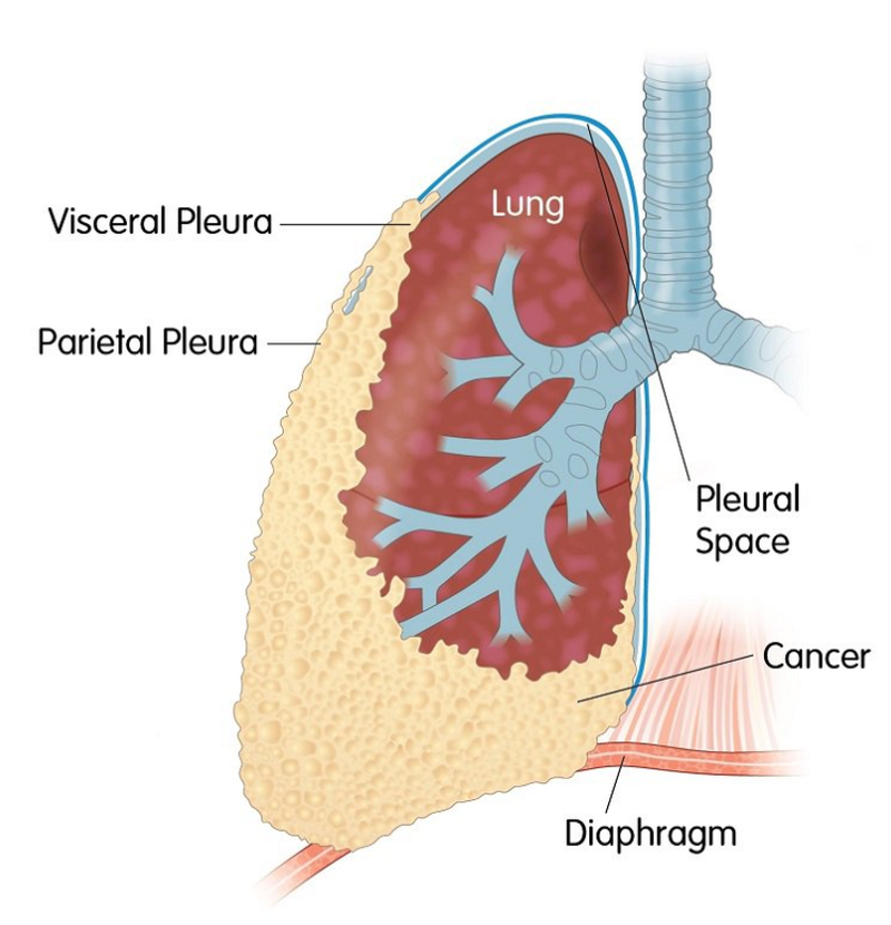 Ung thư màng phổi là gì? Ung thư màng phổi có nguy hiểm không? 1