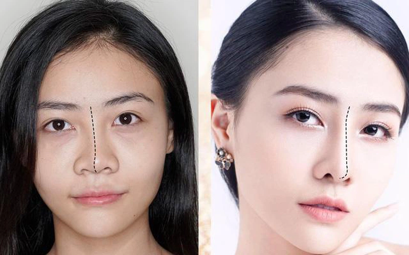 Ưu điểm khi nâng mũi cấu trúc 4D