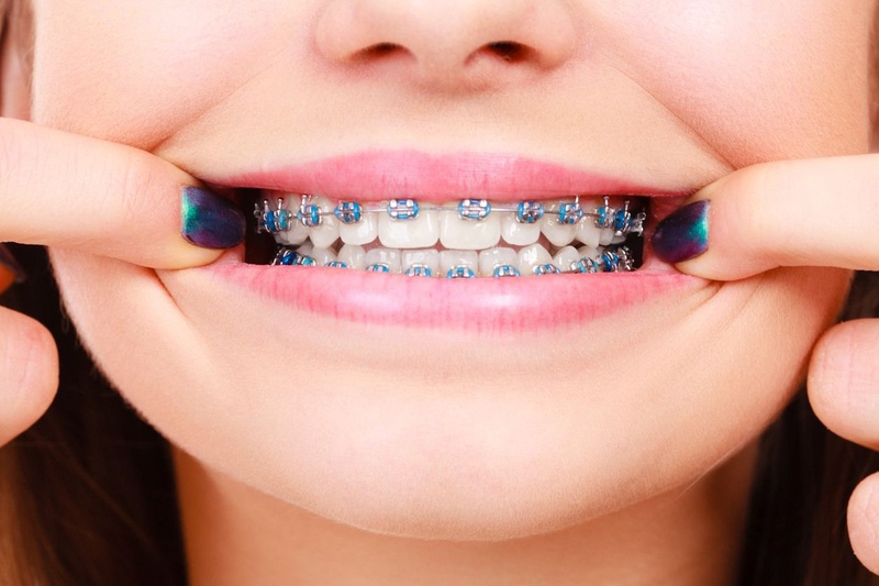 30 tuổi có niềng răng được không? Nếu niềng thì mất bao nhiêu thời gian?