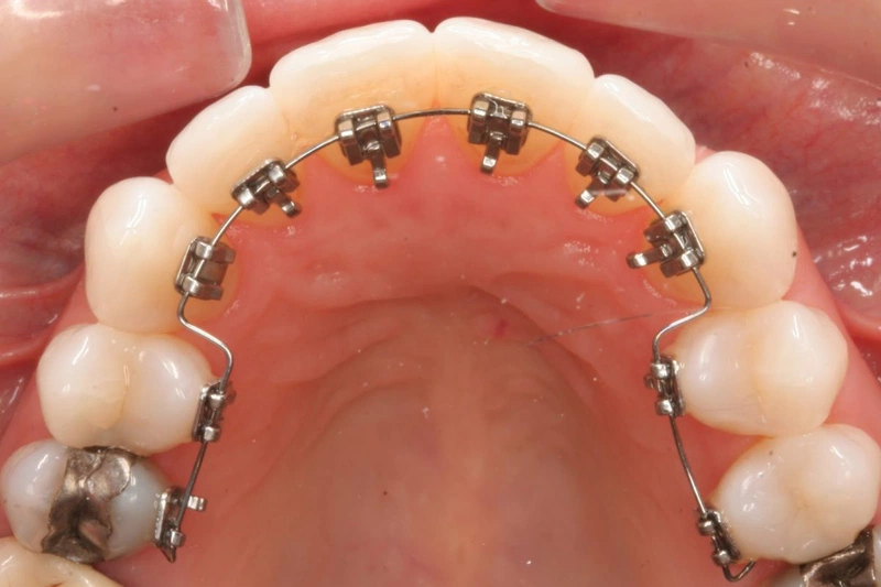 Niềng răng với mắc cài kim loại ở bên trong là phương pháp được đánh giá cao về tính thẩm mỹ