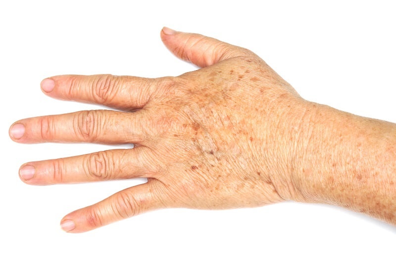 Trị đồi mồi bằng dầu dừa hiệu quả như thế nào