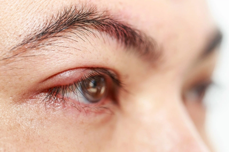 Lẹo mắt bên ngoài và cách điều trị lẹo mắt hiệu quả tại nhà 2