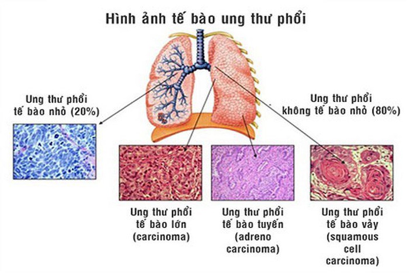 Điều trị ung thư phổi đột biến gen EGFR như thế nào? 1