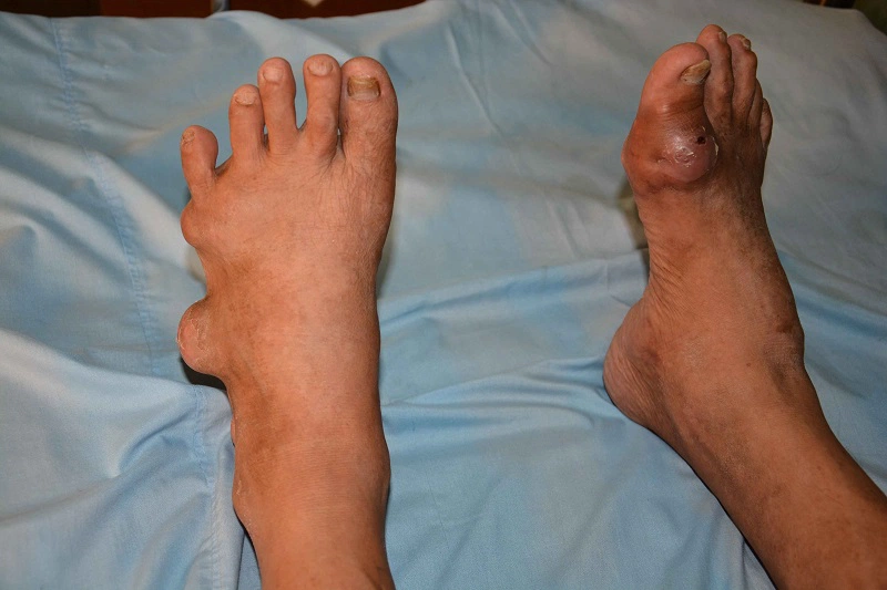 Tìm hiểu về bệnh gout để tránh biến chứng về sau 1