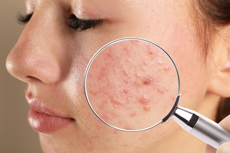 Mụn nội tiết là gì?
