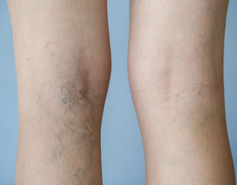 3 bài thuốc Đông y trị suy giãn tĩnh mạch 1