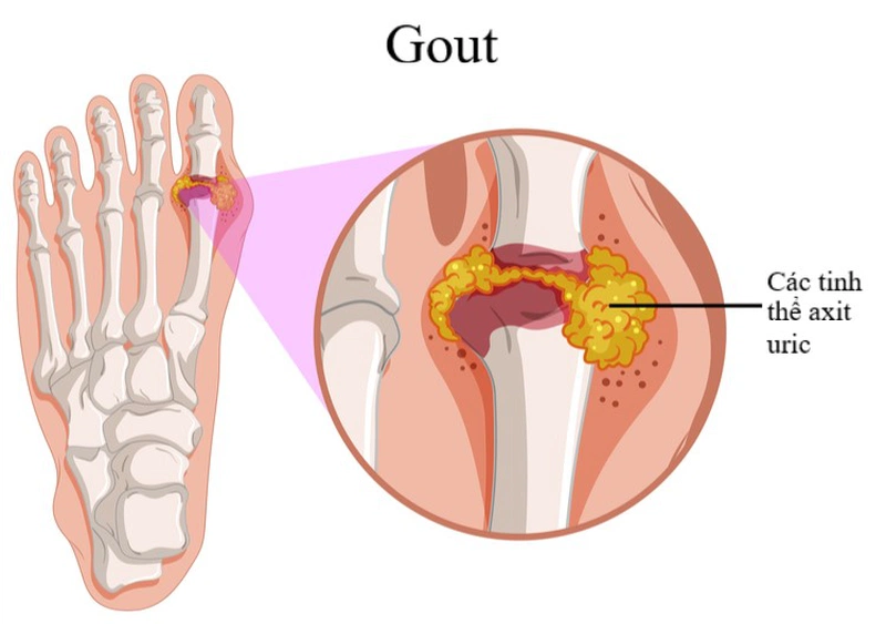 3 bài thuốc trị gout hiệu quả ngay tại nhà 2