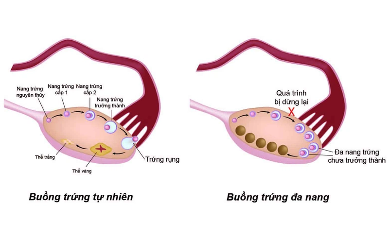 3 căn bệnh phụ khoa dễ gây vô sinh ở nữ giới 1