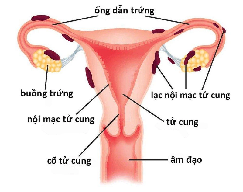 3 căn bệnh phụ khoa dễ gây vô sinh ở nữ giới 3