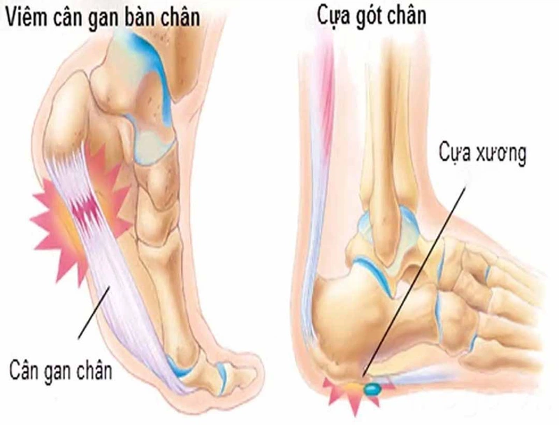 3 loại thuốc đặc trị viêm cân gan chân. Làm sao để phòng tránh biến chứng viêm cân gan chân? 1