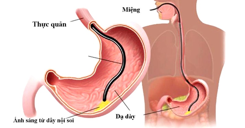 Nội soi giúp bác sĩ chẩn đoán chính xác nhất các bệnh lý liên quan đến hệ tiêu hóa, trong đó có bệnh dạ dày