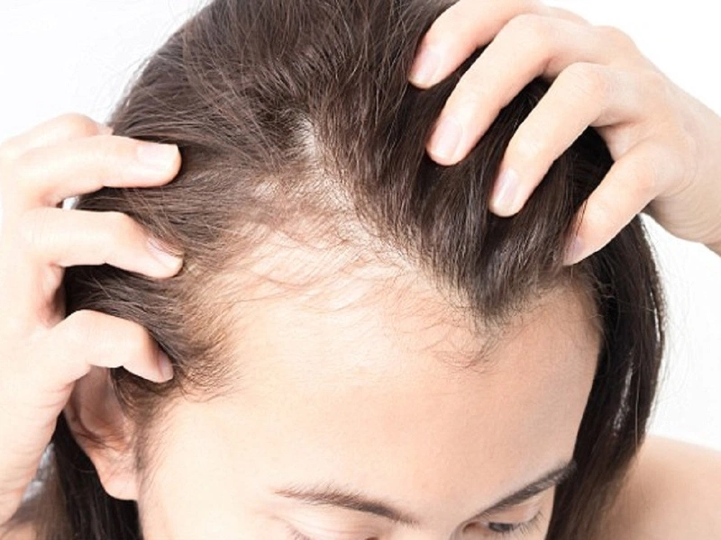 3 tiêu chí lựa chọn dầu gội trị gàu tốt cho da đầu 2