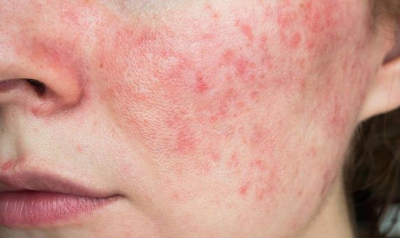 4 bệnh tự miễn dịch phổ biến ảnh hưởng đến phụ nữ 2