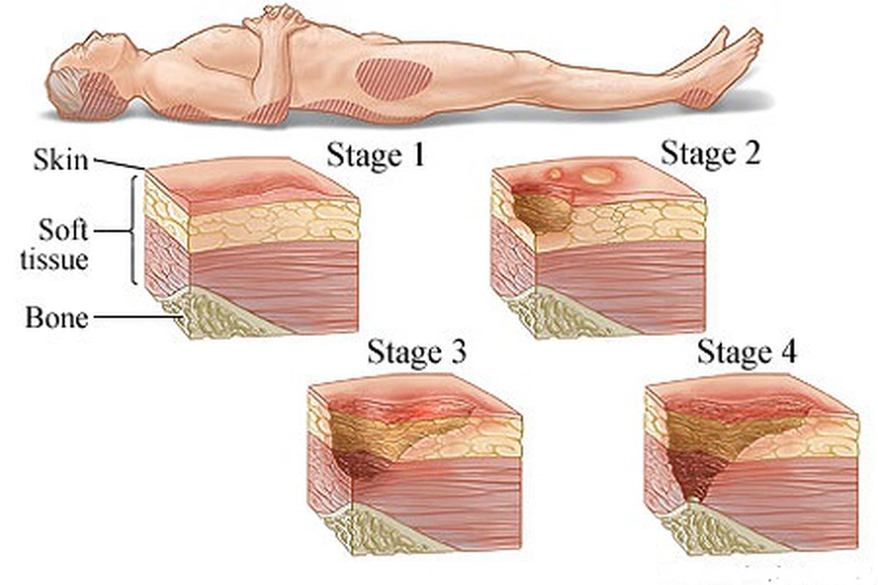 Chăm sóc loét tỳ đè cho bệnh nhân nằm một chỗ 2