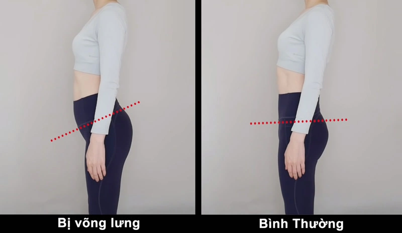 Võng lưng có liên quan đến các nhóm cơ yếu và các nhóm cơ bị căng