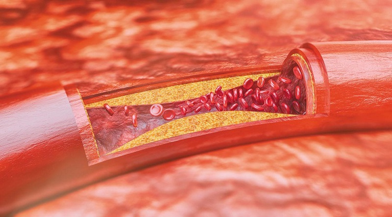 Xơ vữa động mạch do rối loạn lipid máu hạn chế sự lưu thông cung cấp máu giàu dinh dưỡng cho các cơ quan