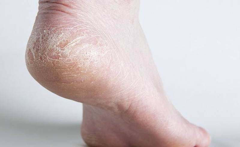 5 cách trị nứt gót chân sau khi sinh hiệu quả cho mẹ bỉm 1