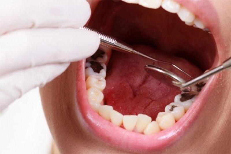 Khi sâu răng trở nên nghiêm trọng, người bệnh sẽ phải chịu những cơn đau răng liên tục