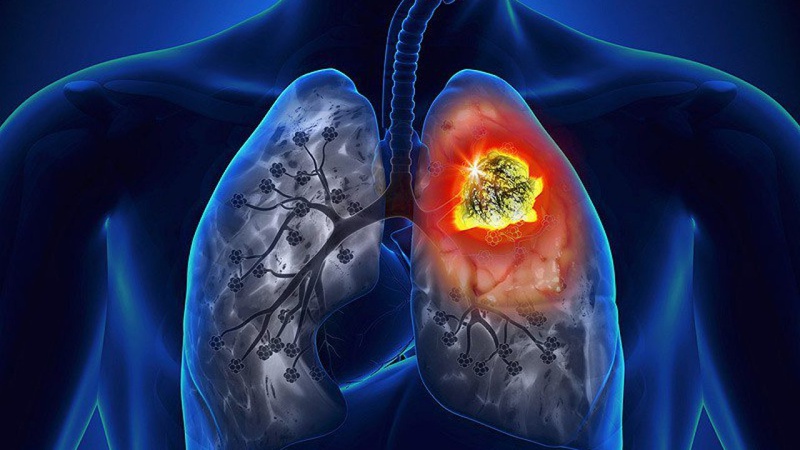 Ung thư phổi là tình trạng xuất hiện khối u ác tính trong các mô phổi