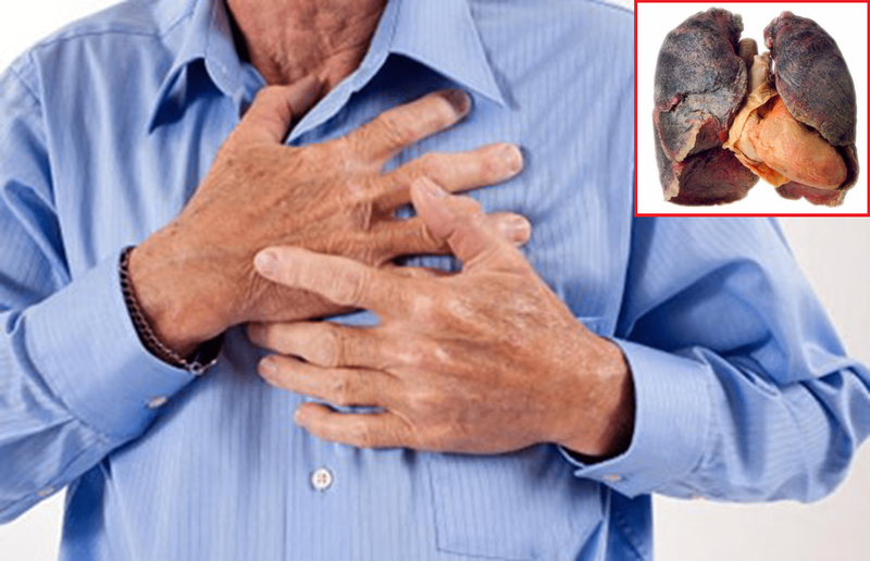 Khi ung thư phổi đã di căn đến thành ngực sẽ dẫn đến hiện tượng đau tức ngực