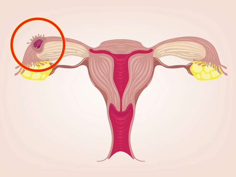 5 nguyên nhân đau bụng dưới bên phải thường gặp 4