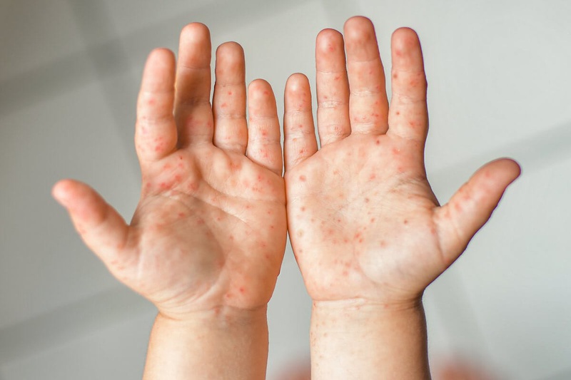 5 nhóm bệnh dễ gặp ở trẻ em vào mùa mưa 2