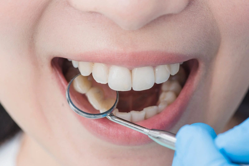 Top 5 cách chữa viêm lợi có mủ tại nhà hiệu quả nhất 1