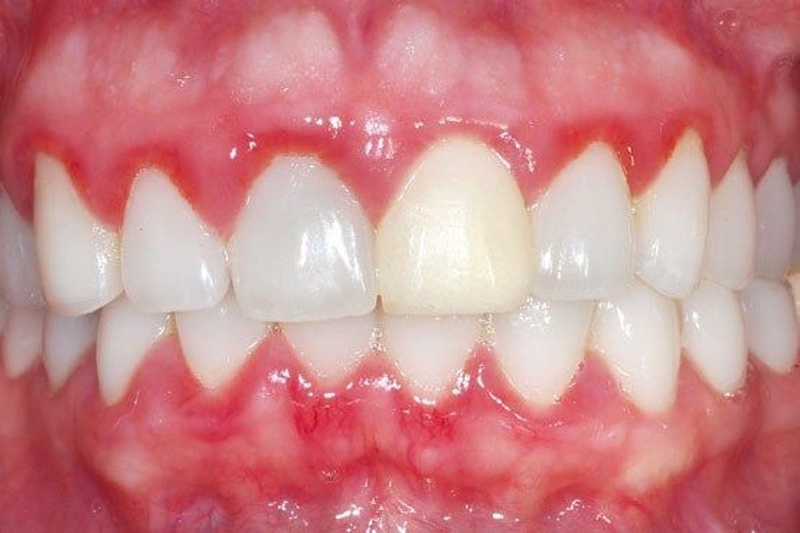 6 bệnh răng miệng thường gặp 2