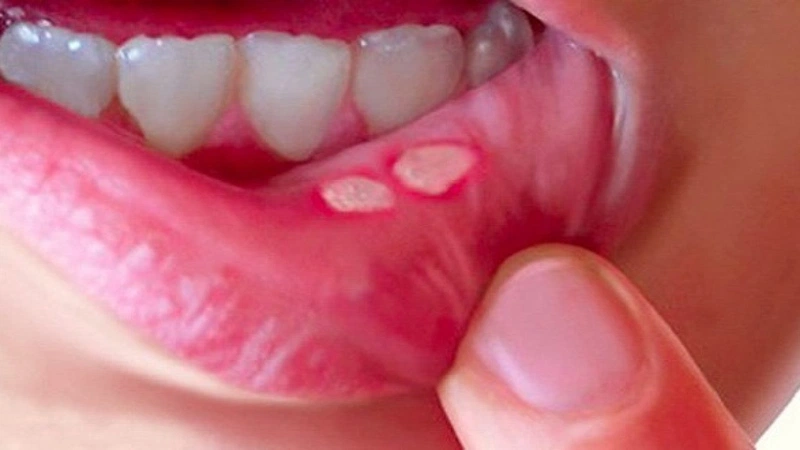 6 bệnh răng miệng thường gặp 5